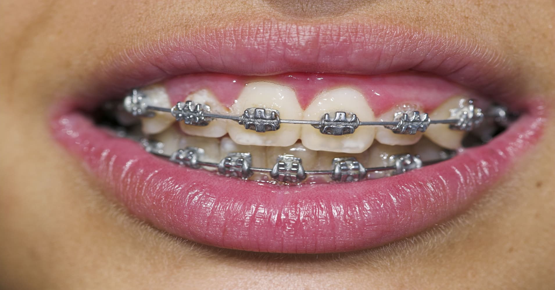 Fake Braces Trend Takes Asia By Storm 